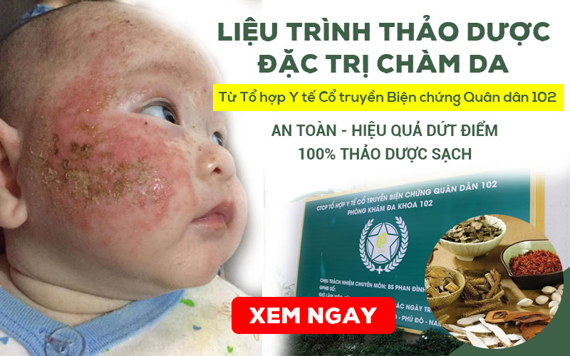 Liệu trình thảo dược ĐẶC TRỊ bệnh Chàm (Eczema) Quân Dân 102 hiệu quả, an toàn với trẻ nhỏ