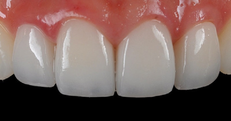 Khi răng có các khuyết điểm nhỏ thì bạn nên bọc răng sứ