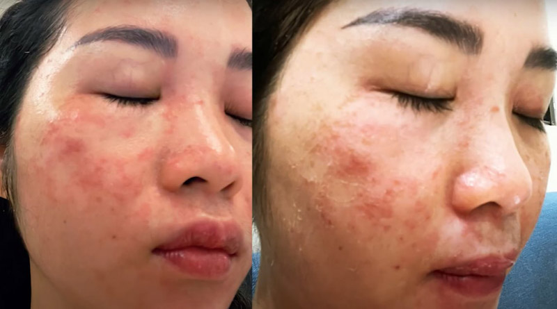 Làn da bị tổn thương của chị Ngô Huyền Trang sau khi áp dụng công nghệ laser không phù hợp