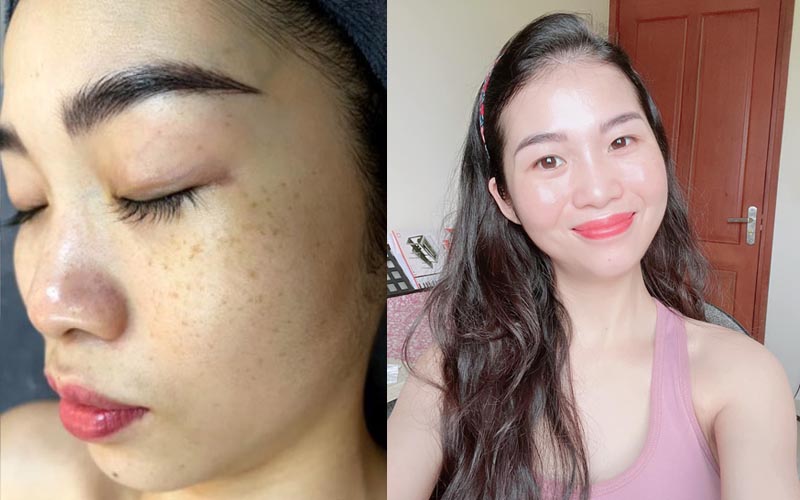 Làn da của chị Trang thay đổi ngoạn mục sau hơn 3 tháng dùng Vương Phi