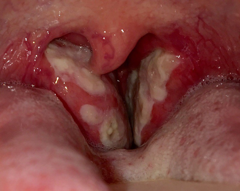 Viêm họng hạt có mủ là diễn biến nghiêm trọng của bệnh viêm họng mãn tính
