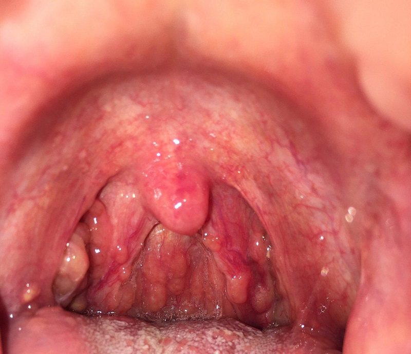 Bệnh viêm họng mãn tính là tình trạng người bệnh bị viêm họng kéo dài dai dẳng