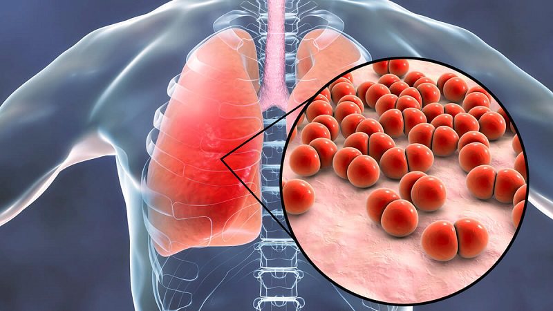 Bệnh có thể gây biến chứng viêm phổi nếu không được điều trị đúng cách
