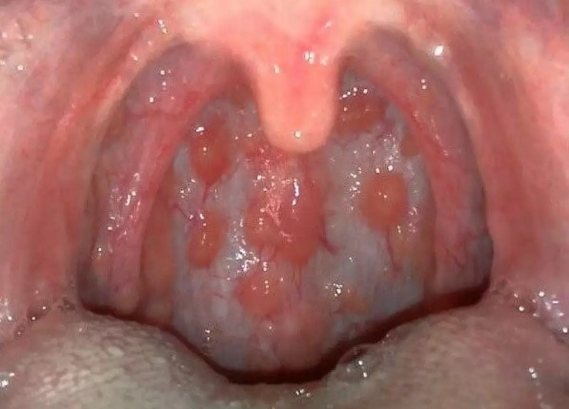 Triệu chứng viêm họng hạt mãn tính